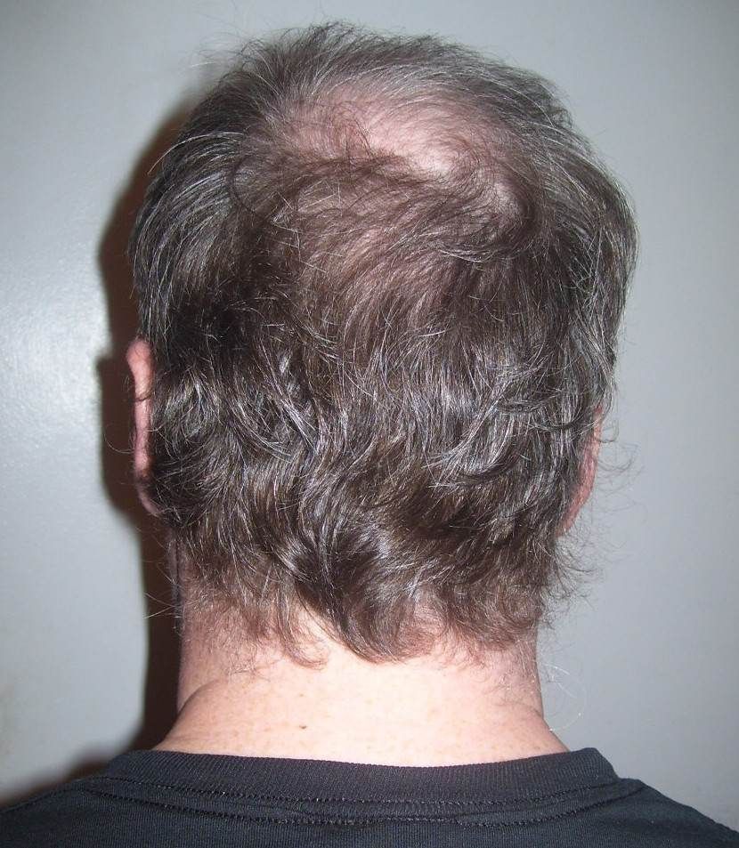 The back of a man’s head, with thinning across the crown.